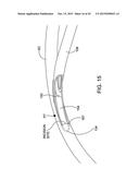 DELIVERING OCULAR IMPLANTS INTO THE EYE diagram and image