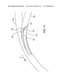 DELIVERING OCULAR IMPLANTS INTO THE EYE diagram and image