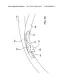 DELIVERING OCULAR IMPLANTS INTO THE EYE diagram and image