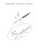 DELIVERING OCULAR IMPLANTS INTO THE EYE diagram and image