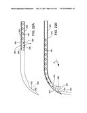 DELIVERING OCULAR IMPLANTS INTO THE EYE diagram and image