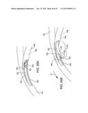 DELIVERING OCULAR IMPLANTS INTO THE EYE diagram and image