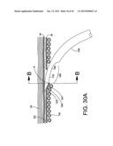 DELIVERING OCULAR IMPLANTS INTO THE EYE diagram and image