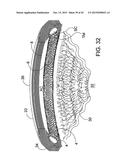 DELIVERING OCULAR IMPLANTS INTO THE EYE diagram and image