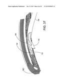 DELIVERING OCULAR IMPLANTS INTO THE EYE diagram and image