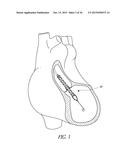 SENSORS FOR CATHETER PUMPS diagram and image