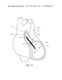 SENSORS FOR CATHETER PUMPS diagram and image