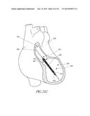 SENSORS FOR CATHETER PUMPS diagram and image