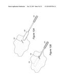 TOOLS AND INSTRUMENTS FOR USE WITH IMPLANTABLE ENCSAPSULATION DEVICES diagram and image