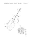 TOOLS AND INSTRUMENTS FOR USE WITH IMPLANTABLE ENCSAPSULATION DEVICES diagram and image