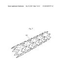 STENT diagram and image