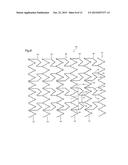 STENT diagram and image