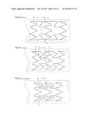 STENT diagram and image