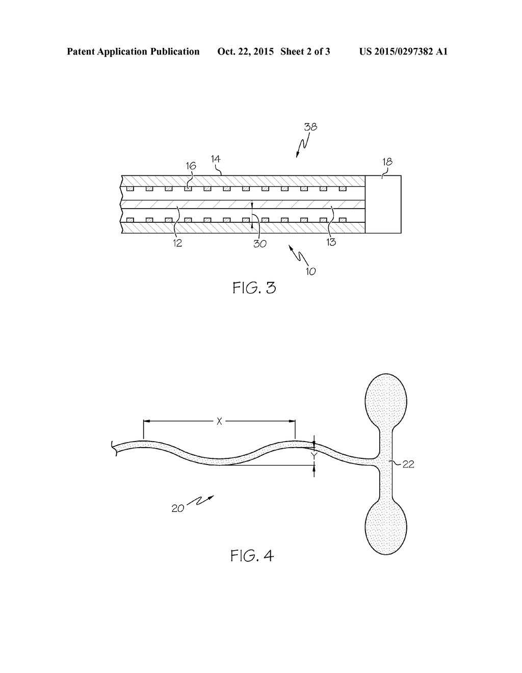 Apparatus For Reducing Deployment Forces In A Self-Expanding Stent     Delivery System - diagram, schematic, and image 03