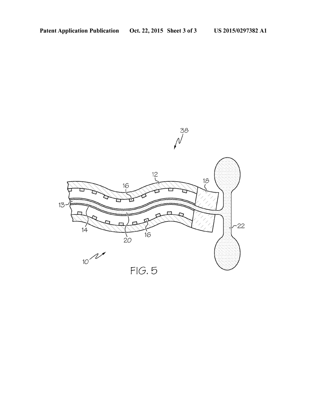 Apparatus For Reducing Deployment Forces In A Self-Expanding Stent     Delivery System - diagram, schematic, and image 04