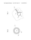 CATHETER FOR ADMINISTERING ACTIVE AGENTS diagram and image