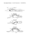 SYSTEMS AND METHODS FOR SHUNTING FLUID diagram and image