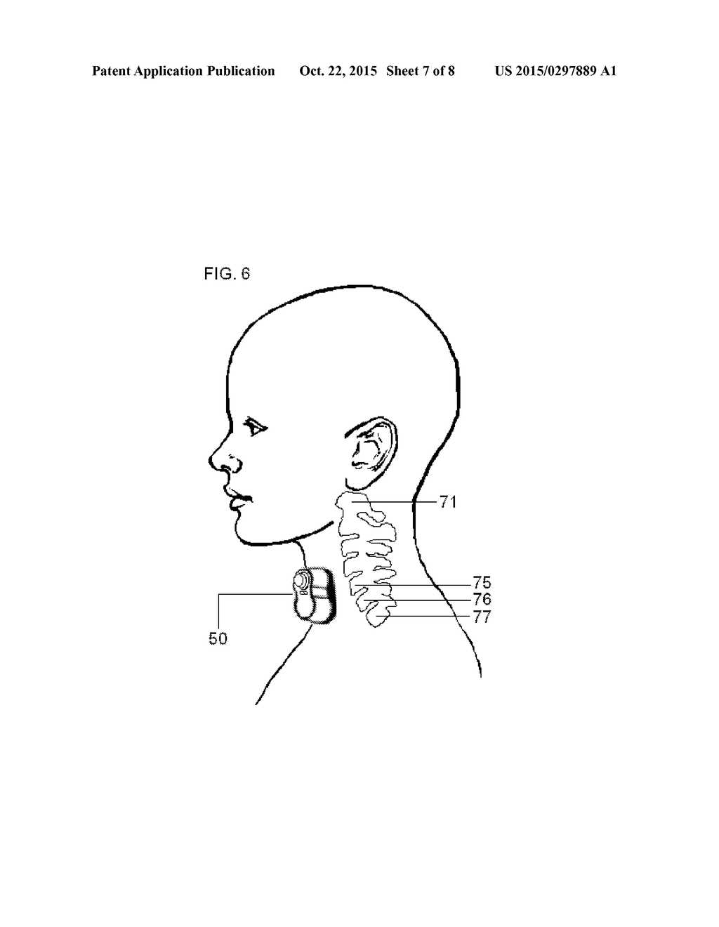DEVICES AND METHODS FOR NON-INVASIVE CAPACITIVE ELECTRICAL STIMULATION AND     THEIR USE FOR VAGUS NERVE STIMULATION ON THE NECK OF A PATIENT - diagram, schematic, and image 08