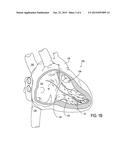 Leadless Cardiac Pacemaker with Secondary Fixation Capability diagram and image