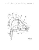 Leadless Cardiac Pacemaker with Secondary Fixation Capability diagram and image