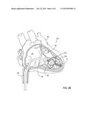 Leadless Cardiac Pacemaker with Secondary Fixation Capability diagram and image