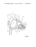 Leadless Cardiac Pacemaker with Secondary Fixation Capability diagram and image