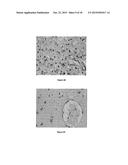 METHODS OF DIAGNOSING PROLIFERATIVE DISORDERS diagram and image