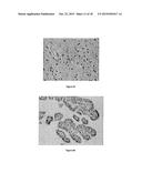 METHODS OF DIAGNOSING PROLIFERATIVE DISORDERS diagram and image