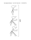 INFLATABLE EAR DEVICE diagram and image