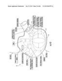 INFLATABLE EAR DEVICE diagram and image