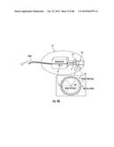 INFLATABLE EAR DEVICE diagram and image