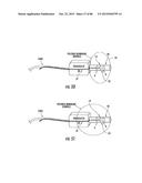 INFLATABLE EAR DEVICE diagram and image