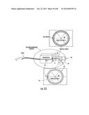 INFLATABLE EAR DEVICE diagram and image