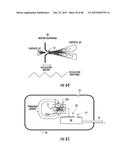 INFLATABLE EAR DEVICE diagram and image