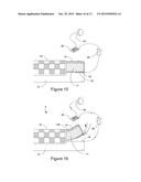 NESTABLE ANTI-LIGATIVE BED LINEN SYSTEM AND DEVICE diagram and image