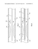 Catheter With Inner Surface Pressure Sensor for Providing a Vascular     Pressure Measurement for Determining Fractional Flow Reserve diagram and image