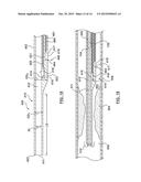 Catheter With Inner Surface Pressure Sensor for Providing a Vascular     Pressure Measurement for Determining Fractional Flow Reserve diagram and image