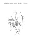 Patient-Mounted Micro Vein Enhancer diagram and image