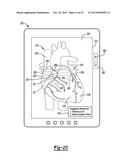 Guidance System For Localization And Cannulation Of the Coronary Sinus diagram and image