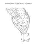 KITS AND METHODS FOR VISUALIZING A CARDIAC CHAMBER FOR CONNECTION TO A     MECHANICAL CIRCULATORY SUPPORT DEVICE diagram and image