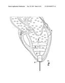 KITS AND METHODS FOR VISUALIZING A CARDIAC CHAMBER FOR CONNECTION TO A     MECHANICAL CIRCULATORY SUPPORT DEVICE diagram and image