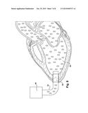 KITS AND METHODS FOR VISUALIZING A CARDIAC CHAMBER FOR CONNECTION TO A     MECHANICAL CIRCULATORY SUPPORT DEVICE diagram and image