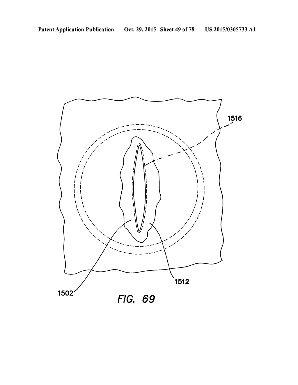 WOUND RETRACTOR WITH SPLIT HOOPS - diagram, schematic, and image 50