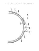 WOUND RETRACTOR WITH SPLIT HOOPS diagram and image