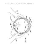 WOUND RETRACTOR WITH SPLIT HOOPS diagram and image