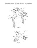 SPINAL STABILIZATION SYSTEM AND METHOD diagram and image