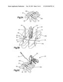 BONE FIXATION ASSEMBLY diagram and image