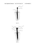 REINFORCEMENT STRUCTURE FOR CORONAL-RADICULAR DENTAL RECONSTITUTION,     METHOD FOR PERFORMING CORONAL-RADICULAR DENTAL RECONSTITUTION,     CORONAL-RADICULAR DENTAL RECONSTITUTION diagram and image