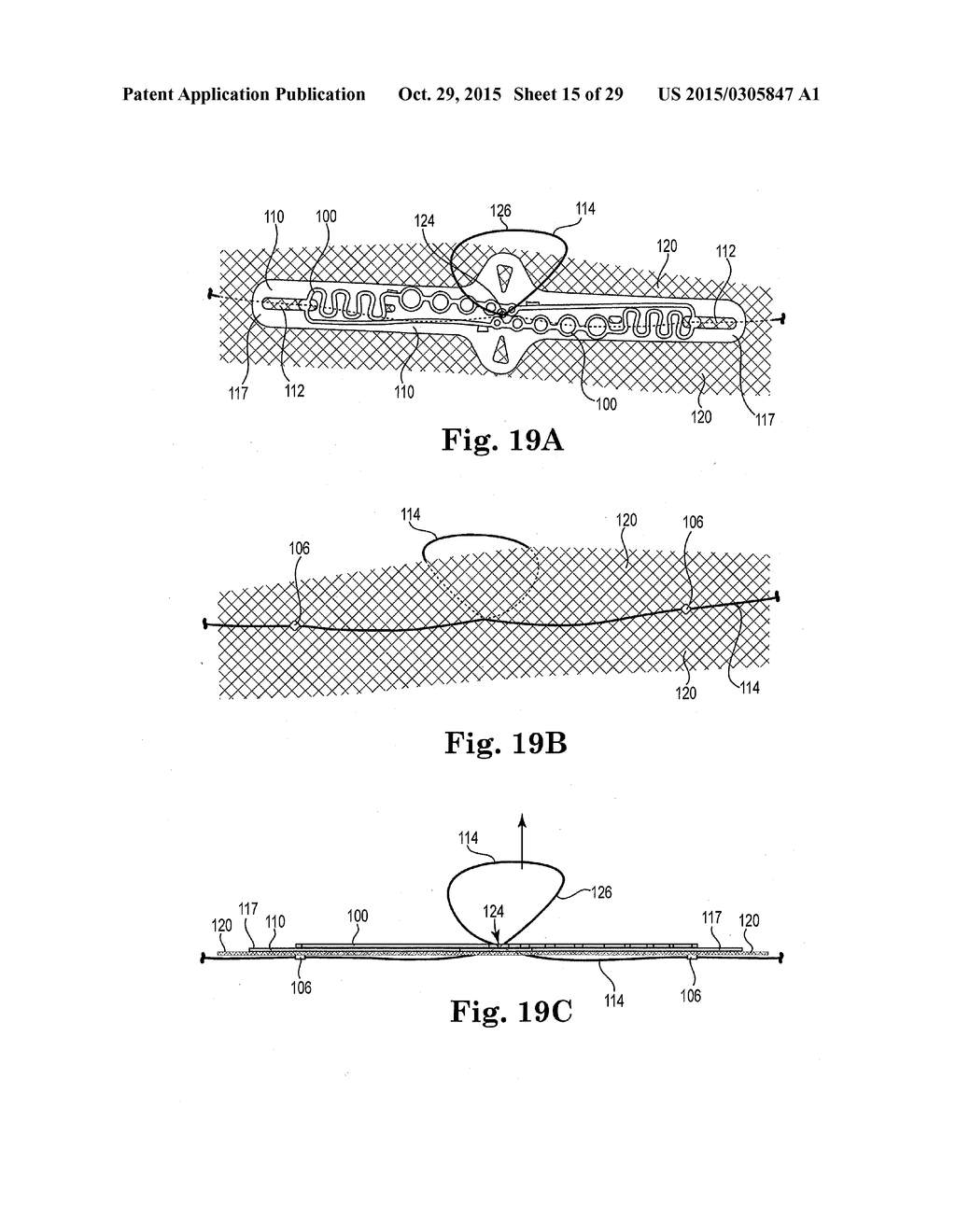 IMPLANTS, TOOLS, AND METHODS FOR TREATMENTS OF PELVIC CONDITIONS - diagram, schematic, and image 16