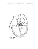 PROSTHETIC HEART VALVE DELIVERY APPARATUS diagram and image